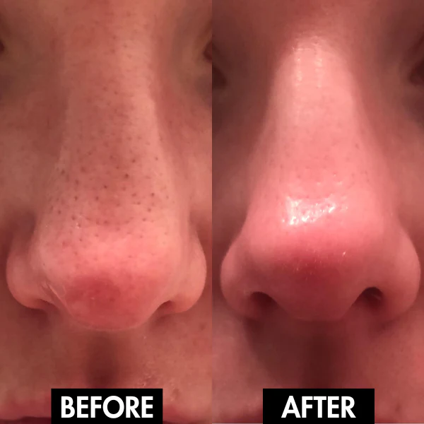 Blackhead Remover Pore Vacuum