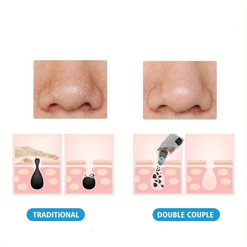 Blackhead Remover Pore Vacuum