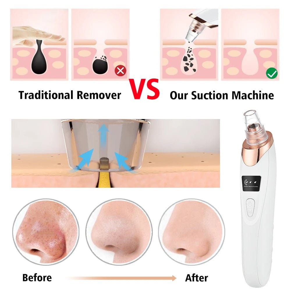 Blackhead Remover Pore Vacuum